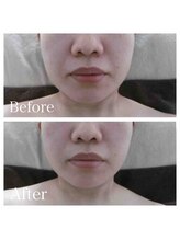 ブランシェ 野々市店 × 椿/シワ・たるみケア　お客様