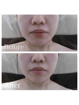 ブランシェ 野々市店 × 椿/シワ・たるみケア　お客様