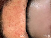 ウォーム(warm)/肌質改善専門店warm/ニキビケア