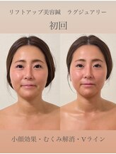 めい鍼灸院/美容鍼灸　ビフォーアフター