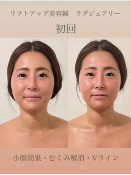 めい鍼灸院/美容鍼灸 ビフォーアフター