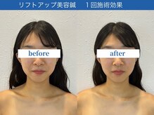 ラ カルナベル(La Carnabel)/美容鍼/耳つぼジュエリー/小顔