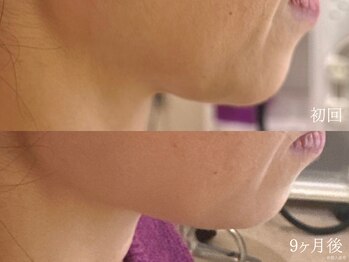 ウォーム(warm)/【肌質改善専門店warm】シワケア