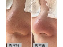 ココ(coco)の雰囲気（羽曳野市広瀬サロン♪大人気！REVI陶肌ハーブピーリング♪）