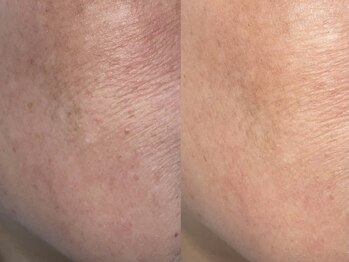 キララ(Kirara)/肌質改善