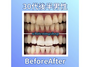 ホワイトニングショップ 西原店/30代後半男性☆BeforeAfter