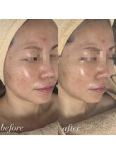 ビューティーサロン プティ(beauty salon petite)/ニキビケア/あかみ/鎮静ケア