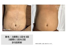 ザ エッセンシャル 碧南(THE Essential)/メンズ 胸＋お腹脱毛（Lパーツ）