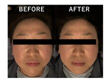 ミシェル(Michell)/印象が変わる小顔矯正