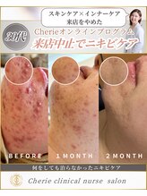 シェリー(Cherie)/施術なし！長年悩むニキビケア