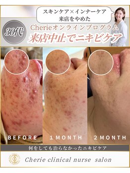 シェリー(Cherie)/施術なし！長年悩むニキビケア