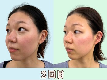 ナチュラルパーフェクトフェイス 新宿/横顔は大切／渋谷区小顔矯正