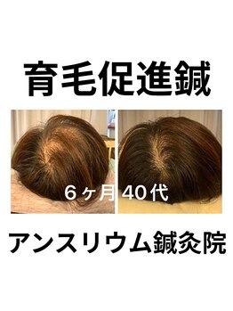 アンスリウム美容整体院 鍼灸院 接骨院の写真/頭皮環境を根本から整え、鍼で強く太い髪へ導く！巡りが変わりボリュームアップで鏡を見るのも楽しくなる◎