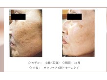 エテル(eter)の雰囲気（エクスビアンスの水光ピールで肌の根本から改善！）