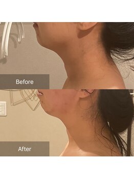 ココシア(cococia)/二重あご・首が長く見える施術