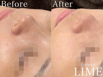 ライム 二子玉川(LIME)/ハーブピーリング｜毛穴洗浄