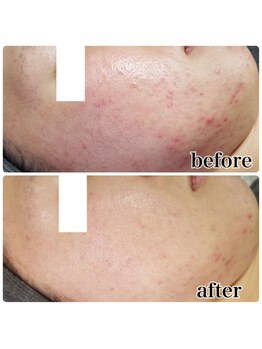 ヴォーグ(Vogue)/パワーライトフェイシャル