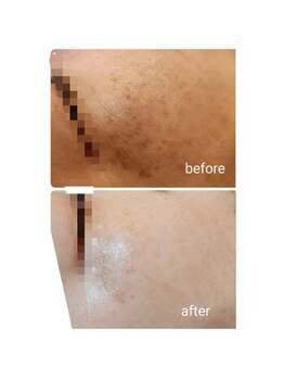 ジャドール ネイルアンドアイラッシュ(J'ADORE)/ハーブピーリング　