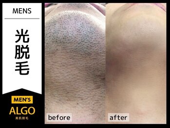 アルゴ 福井店(ALGO)/30代男性 8回目 メンズ髭脱毛