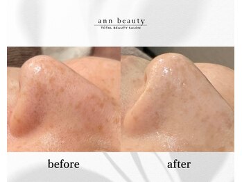 アン ビューティー(ann beauty)/【症例写真】40代女性