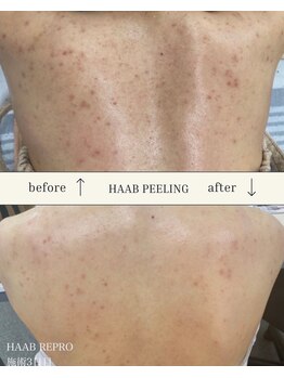 ルアナ(LUANA。)/ハーブピーリング/背中#尾張旭