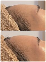 テセラ(Tethere)/ヒアルリッチ額1回の結果写真