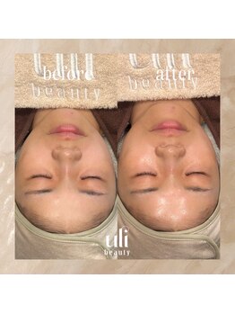 ウリ(uli beauty)/比較写真