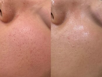 ボーテ 神戸(BEAUTE)の写真/【本気の毛穴改善】黒ずみ・角栓・開き毛穴に徹底アプローチ！結果重視のピーリング特化サロン