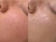 ボーテ 神戸(BEAUTE)の写真/【本気の毛穴改善】黒ずみ・角栓・開き毛穴に徹底アプローチ！結果重視のピーリング特化サロン