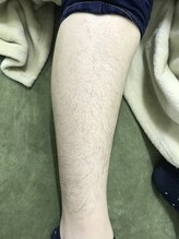 ナノハナ/鹿沼市全身脱毛ナノハナ