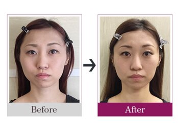 ビコツゼロ 青山(BIKOTSU ZERO)/小顔・頬骨の出っ張り・むくみ