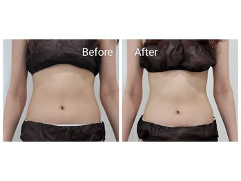 レスプロンディール(Resplendir)/ぽっこりお腹・くびれスッキリ☆