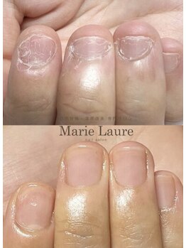 マリーロール 天王寺店(Marie Laure)/自爪育成/深爪矯正/ネイルケア
