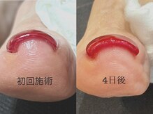 ネイルサロン マリア(nail salon Maria)の雰囲気（全員OK!　巻き爪改善ジェル＋FＯＯＴジェルワンカラ―￥８８００）