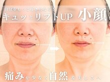 小顔リンパマッサージヘッドスパでたるみ改善小顔リフトアップ