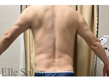 エル(Elle)/痩身１回after