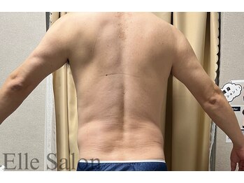 エル(Elle)/痩身1回after