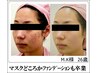 【木、金曜日限定】ゴールデンリフト¥16500→¥13500（ダウンタイムなし）