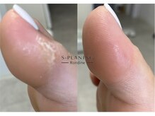 ロンディネ(Rondine)/足裏角質ケア