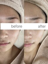 フェリノ(FERINO)/エクソソームハーブ明るい透明感