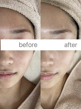 フェリノ(FERINO)/エクソソームハーブ明るい透明感