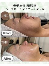 シーフェイス 横浜店(SEE FACE)/ハーブピーリングモニター2回目