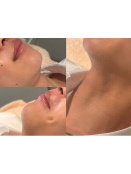 メンズフェイシャル