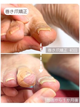 ドクターネイル爪革命 THE KANAZAWA 御経塚/巻き爪ケア
