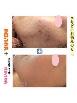アイリス(AIRIS)/毛穴洗浄/ニキビケア/乾燥