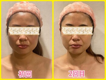 美肌痩身サロン ラエルヴェ(La Elever)/小顔リフトアップ大作戦！ 