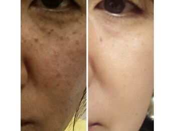 エステティック エルローザ(Esthetique elle Rosa)/おシミ・肌質改善コース