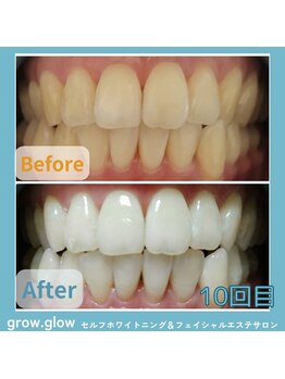 グロウ グロウ(grow.glow)/仙川ホワイトニング