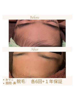 ガムラン(Gamelan)/脱毛