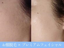 オーシャンブルー 大分店(OCEAN BLUE)/顔脱毛×プレミアムフェイシャル